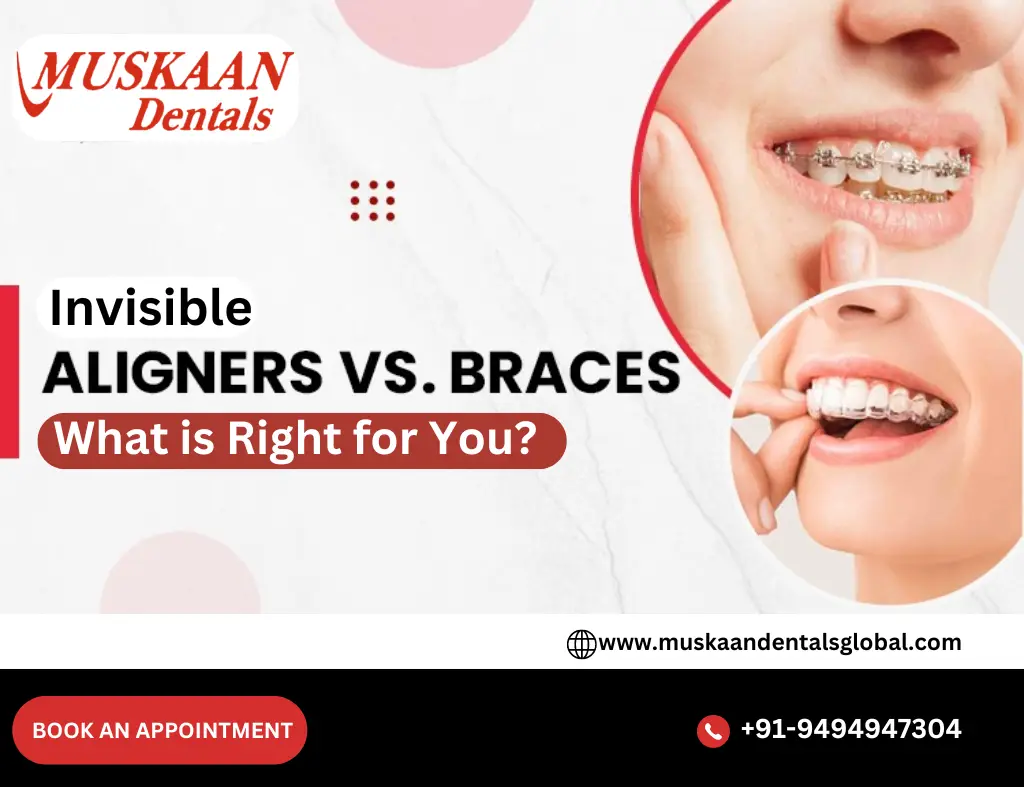 Invisible Aligners or Traditional Braces- What is Right for You?