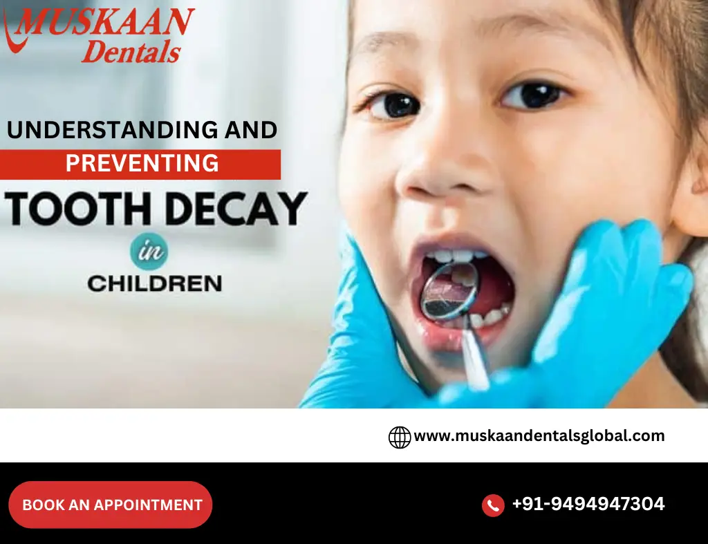 Understanding and Preventing Tooth Decay in Children