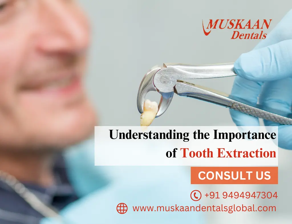 Understanding the Importance of Tooth Extraction