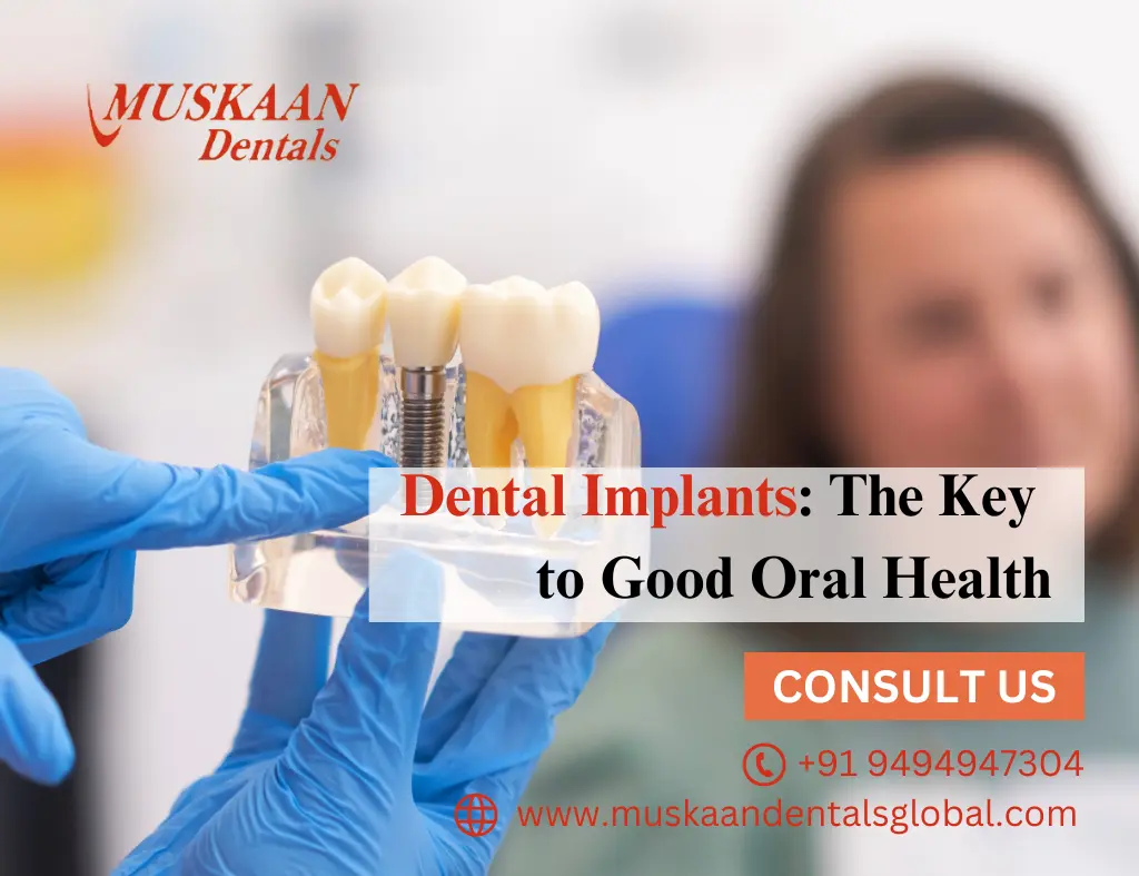 Dental Implants: The Key to Good Oral Health